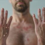 Mpox Atinge Novos Estados E Brasil Soma 90 Confirmações