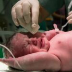 Mudanças Em Uti Neonatal Reduzem Infecções Graves Em Prematuros