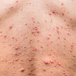 Casos De Sífilis Crescem No Brasil E Acendem Alerta Para Avanço Da Doença